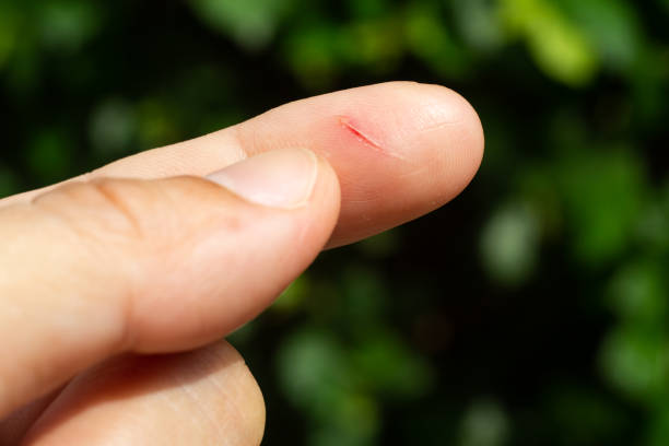 woman has been cut index finger and scar skin on hand, close up & macro shot, asian body skin part, healthcare concept, bokeh green garden background - wound blood human finger human hand imagens e fotografias de stock