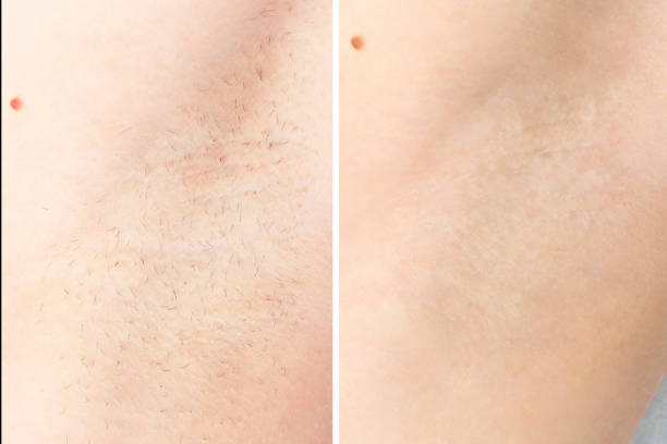 istock waxing cosmetic depilation procedure results before after armpit 1154082962
