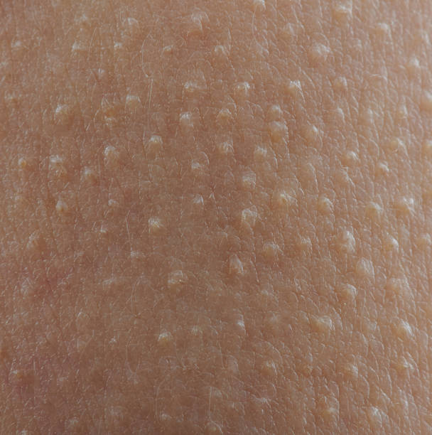 istock Goose bumps on brown skin 1154104003