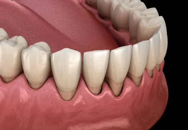 Photo of Gum recession process. Medically accurate 3D illustration
