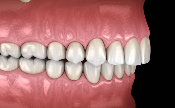 istock Overbite dental occlusion ( Malocclusion of teeth ). Medically accurate tooth 3D illustration 1154324576