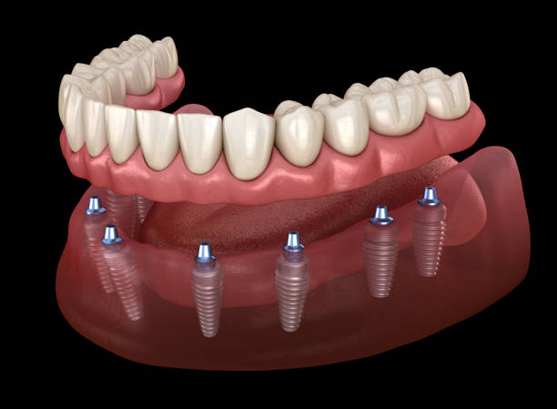 мандибулярный протез все на 8 системе, поддерживаемой имплантатами. медицинская точная 3d иллюстрация человеческих зубов и протезов концеп� - implantat стоковые фото и изображения