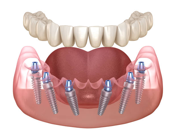 mandibular prosthesis all on 6 system supported by implants. medically accurate 3d illustration of human teeth and dentures concept - implantat imagens e fotografias de stock