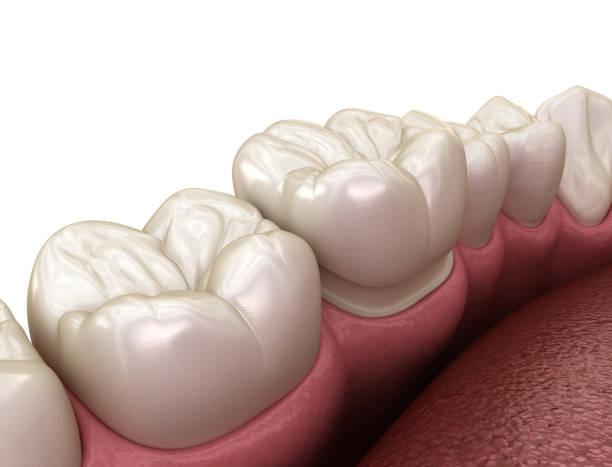 istock Preparated molar tooth for dental crown placement. Medically accurate 3D illustration 1154324692