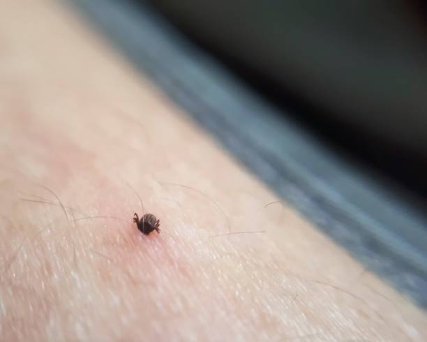 istock Tick with its head sticking in human skin 1154330516