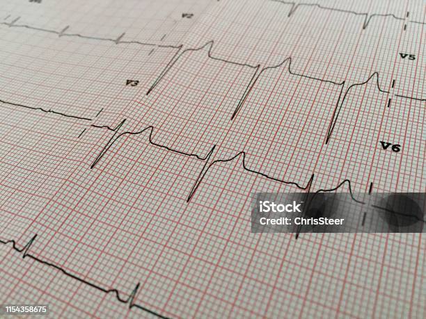 Electrocardiogram Ecg Stock Photo - Download Image Now - Analyzing, Backgrounds, Cardiac Conduction System