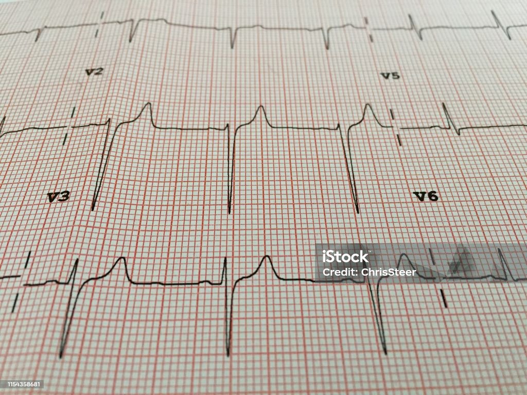 electrocardiogram ECG Analyzing Stock Photo