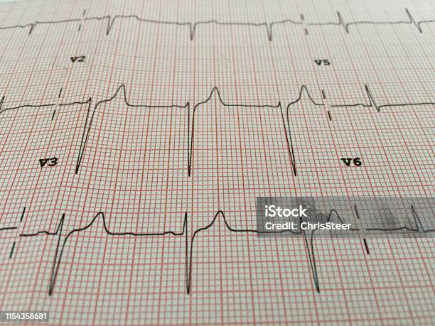 Electrocardiogram Ecg Stock Photo - Download Image Now - Analyzing, Backgrounds, Cardiac Conduction System