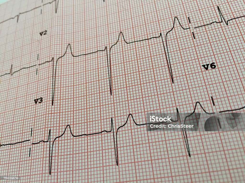 electrocardiogram ECG Analyzing Stock Photo
