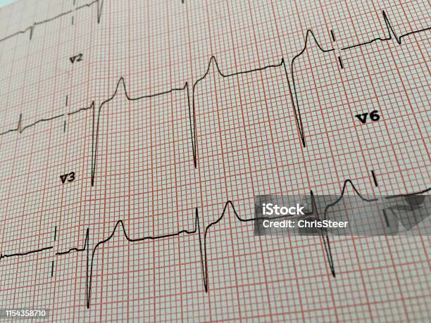 Electrocardiogram Ecg Stock Photo - Download Image Now - Analyzing, Backgrounds, Cardiac Conduction System