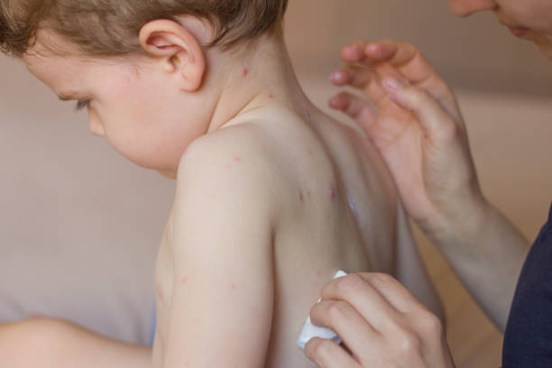 heilende pox durch pox - zoster stock-fotos und bilder