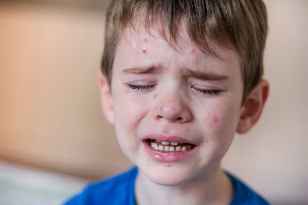 Childhood Nuisance Portrait of a four years old crying boy having chickenpox. measles stock pictures, royalty-free photos & images