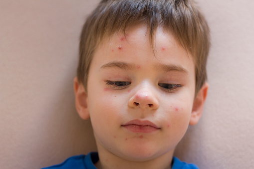 Waiting For Chickenpox To Heal Stock Photo - Download Image Now - 4-5
