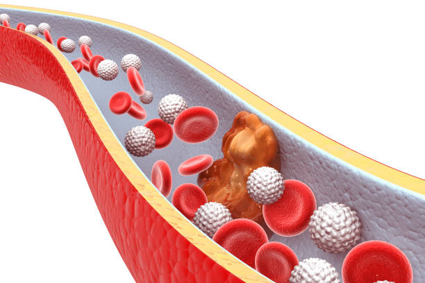 istock Cholesterol plaque in artery 1154559411