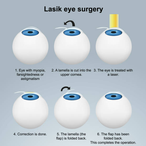 Lasik eye surgery medical vector illustration isolated on white background eps 10 infographic Lasik eye surgery medical vector illustration isolated on white background eps infographic eye doctor and patient stock illustrations