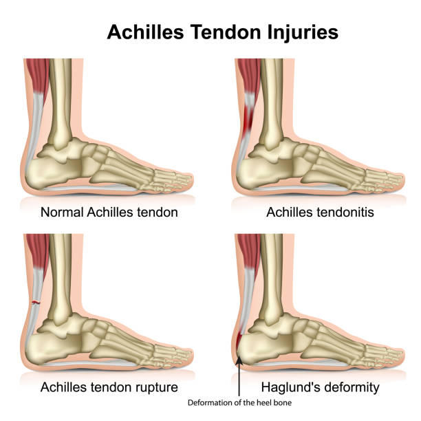 ilustraciones, imágenes clip art, dibujos animados e iconos de stock de tendón de aquiles lesiona la ilustración vectorial médica aislada sobre fondo blanco con descripción en inglés - tendon