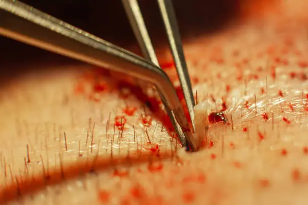 Macrophotography of a hair bulb transplanted into a hairless area. Baldness treatment. Hair transplant. Surgeons in the operating room carry out hair transplant surgery. Surgical technique that moves hair follicles from a part of the head