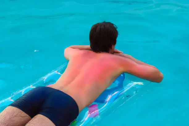 Young man lying on an air mattress in a pool with first degree sunburns on his shoulders, back and arms. Unrecognizable Caucasian male.