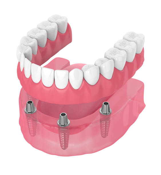 istock 3d render of removable full implant denture 1154821217