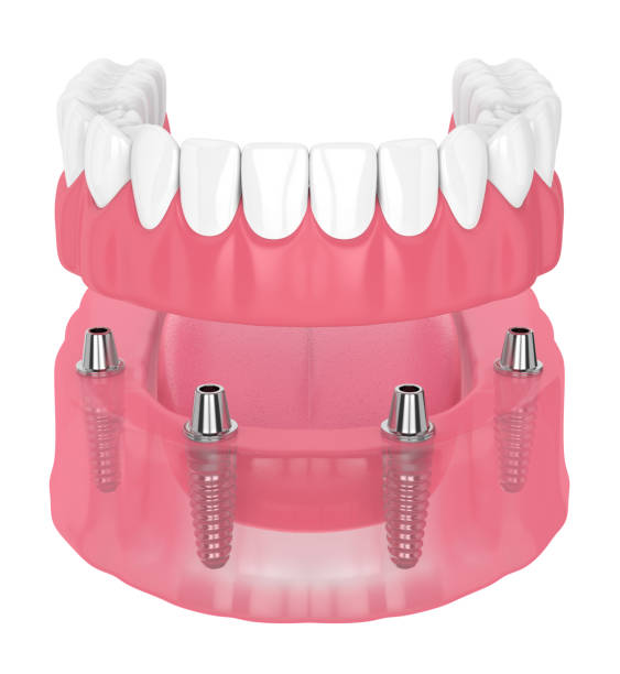 istock 3d render of removable full implant denture 1154821221
