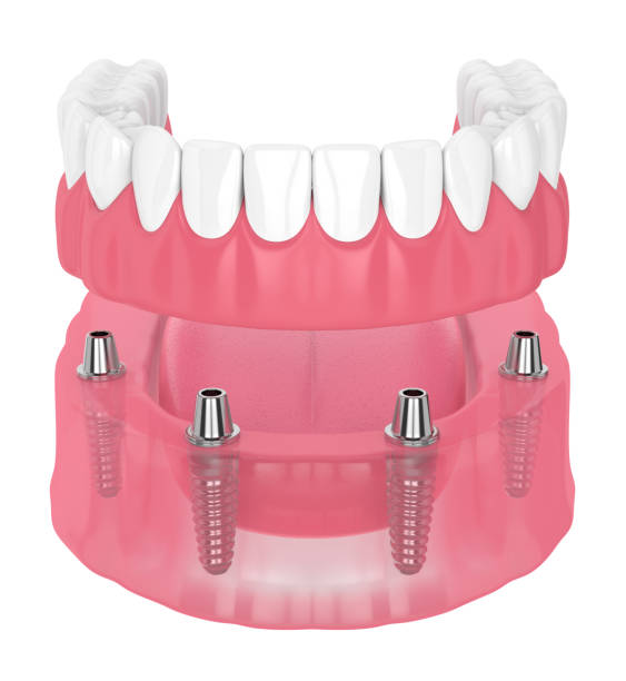 3d визуализация съемного полного зубного протеза имплантата - premolar стоковые фото и изображения