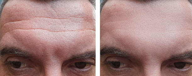 male face wrinkles before and after treatments male face wrinkles before and after treatments botox before and after stock pictures, royalty-free photos & images