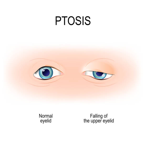 Ptosis is a drooping of the upper eyelid. lazy eye Ptosis is a drooping of the upper eyelid. lazy eye. this disorder is the result of allergies or muscle weakness, it can also be a symptom of thyroid or eye disease. Vector diagram for medical use drooping stock illustrations