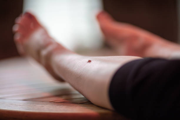 istock an unattractive wart has formed on the shinbone 1154929205