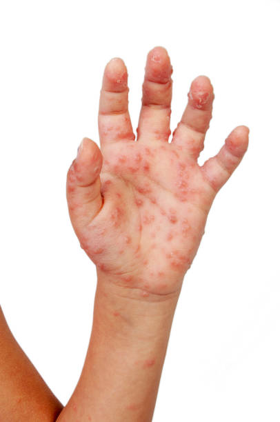 istock Chickenpox varicella zoster virus 1154932166