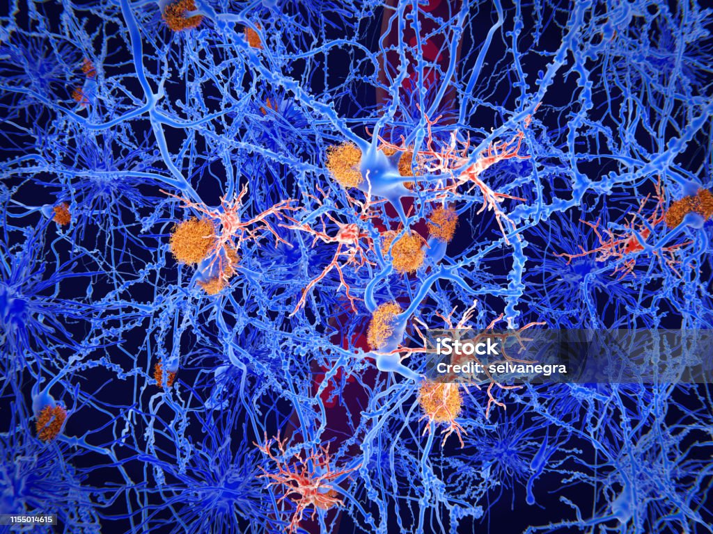 Microglia cells (red) play an important role in the pathogenesis of Alzheimer's disease Microglia are specialised macrophages that restrain the accumulation of ß-amyloid (plaques in orange). On the other side, once activated, they can have harmful influences in Alzheimer's disease, segregating inflammatory factors and mediating the engulfment of synapses. Microglia Stock Photo