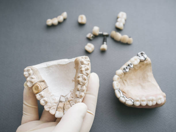istock Orthodontic dentistry gypsym jaw denture forceps 1155091268