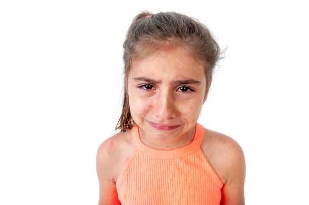 istock Chickenpox varicella zoster virus 1155139888