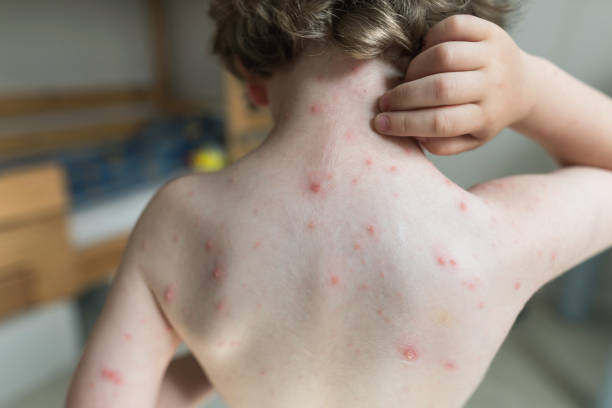 istock Little boy scratching his chickenpox rash 1155180754