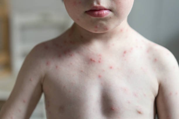 Young boy with varicella zoster virus Front view image of young boy with chickenpox rash on his chest shingles rash stock pictures, royalty-free photos & images