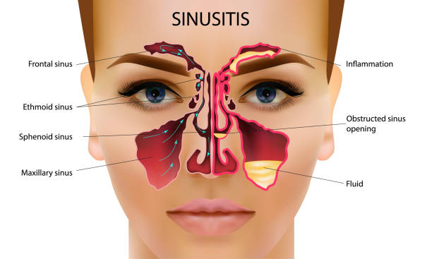 ilustrações, clipart, desenhos animados e ícones de sinusite. saudável e inflamação da cavidade nasal ilustração vetorial - nasal cavity