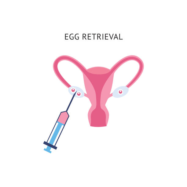ilustrações, clipart, desenhos animados e ícones de recuperação do ovo fêmea para a fertilização - retrieval