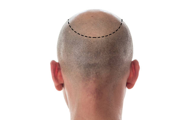 Bald man head on the back Bald man back view, head with hair loss and discontinuous line skin head stock pictures, royalty-free photos & images