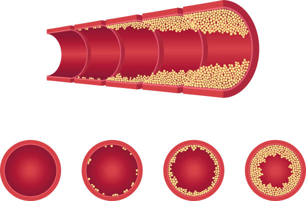 wektor miażdżycy żyły tętnicy tromeryki płaskie zestaw - cholesterol atherosclerosis human artery illness stock illustrations