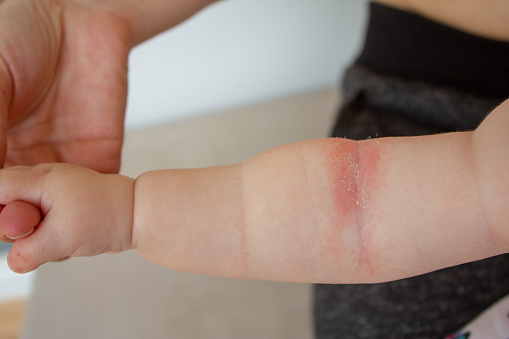 Calor espinoso. Close-up de los pliegues de la mano de un bebé recién nacido con piel roja. photo