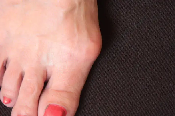 Varus valgus and Hallux valgus or bunion on middle aged woman foot. Isolated closeup on dark background. Concept of treatment or cosmetology help