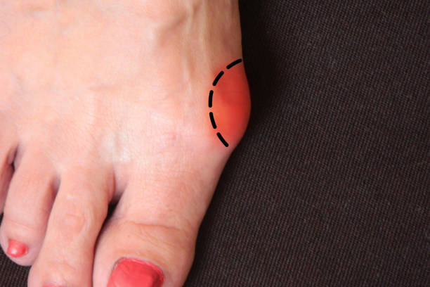 varus valgus e hallux valgus o bunion sul piede della donna di mezza età. primo piano isolato su sfondo scuro. concetto di trattamento o cosmetologia aiuto - misalignment foto e immagini stock