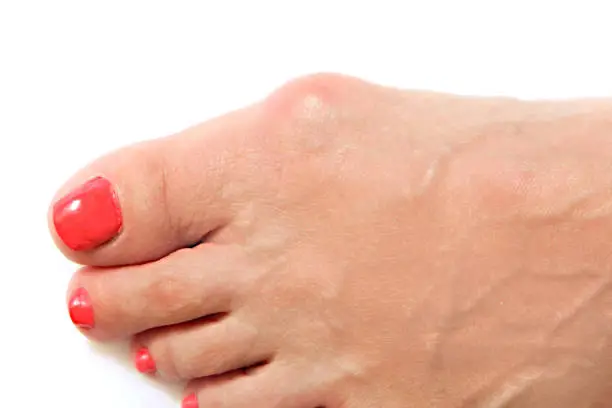 Varus valgus and Hallux valgus or bunion on middle aged woman foot. Isolated closeup on white background. Concept of treatment or cosmetology help