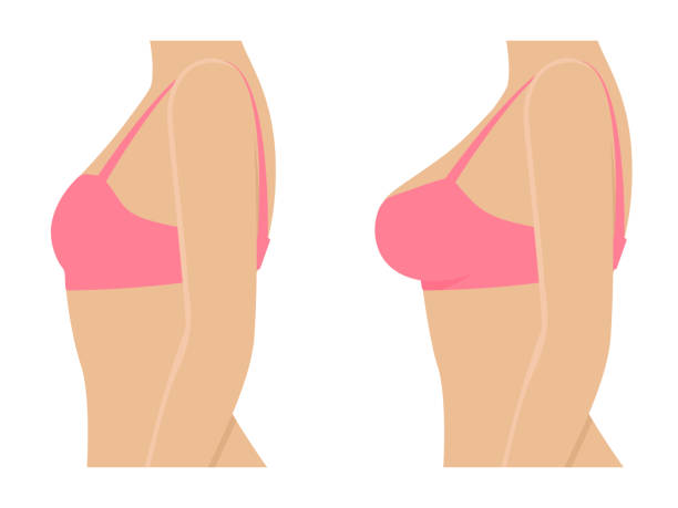 Female breasts in bra before after augmentation Female breasts in bra before and after augmentation. Woman before and after breast size correction. Plastic surgery concept. Vector illustration isolated on white background, side view profile. silicone implants stock illustrations
