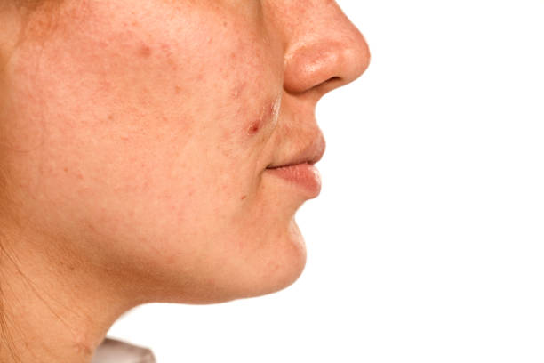 istock closeup of female face with problematic skin on white background 1155612494