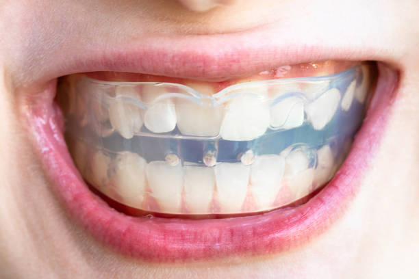 orthodontic trainer for correction of teeth bite in mouth of teenager