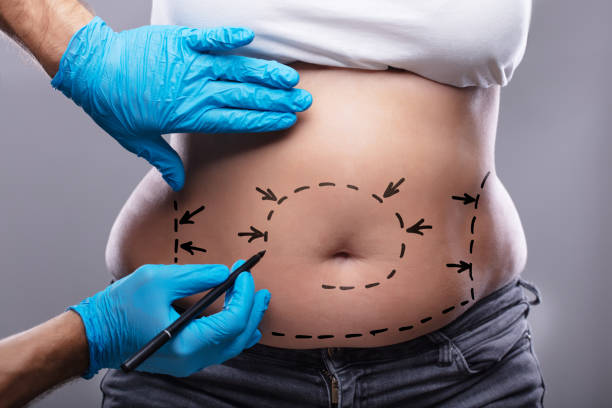 plastic surgeon drawing on woman's body for surgery - liposuction imagens e fotografias de stock