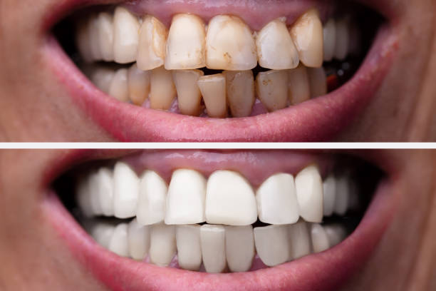 istock Woman Teeth Before And After Dental Treatment 1155812253