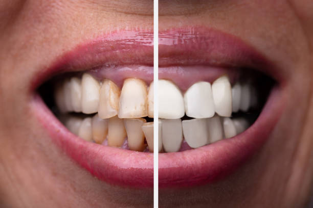 istock Woman Teeth Before And After Dental Treatment 1155812254