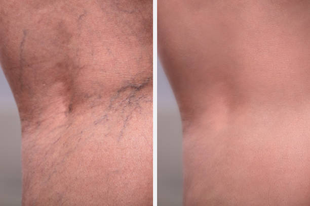 istock Treatment Of Varicose Before And After 1155812258
