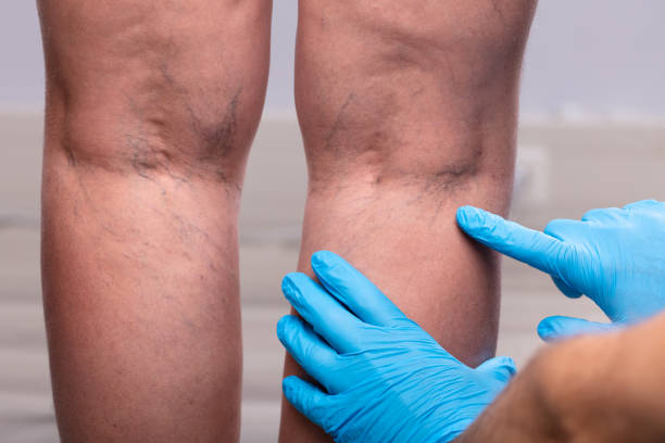 Surgeon Examining Patient's Leg Medic With Blue Latex Surgical Gloves Touching Varicose Veins On Patient's Leg blood clot stock pictures, royalty-free photos & images